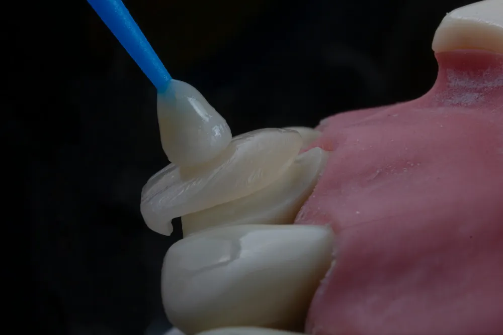 Faceta dentária em cerâmica