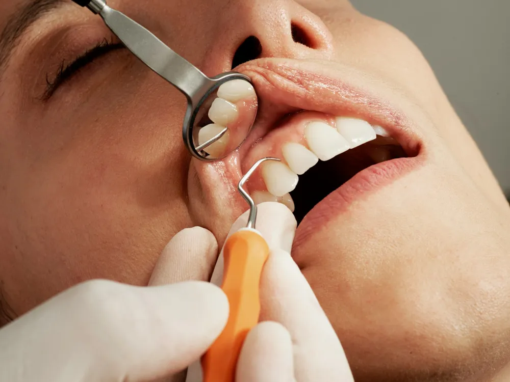 Limpeza dentária profissional