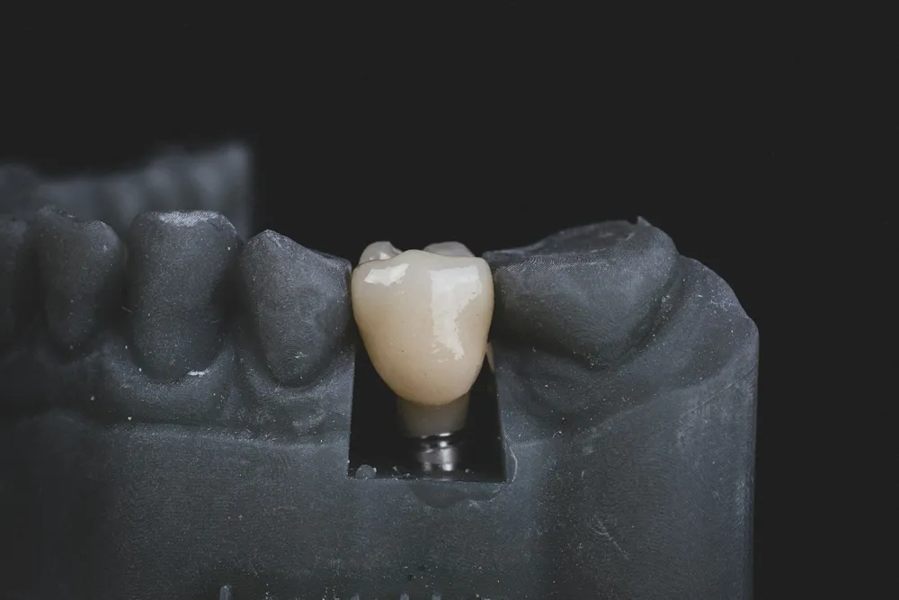 Coroa sobre implante dentário