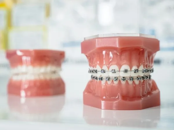 Modelo dentário com aparelho